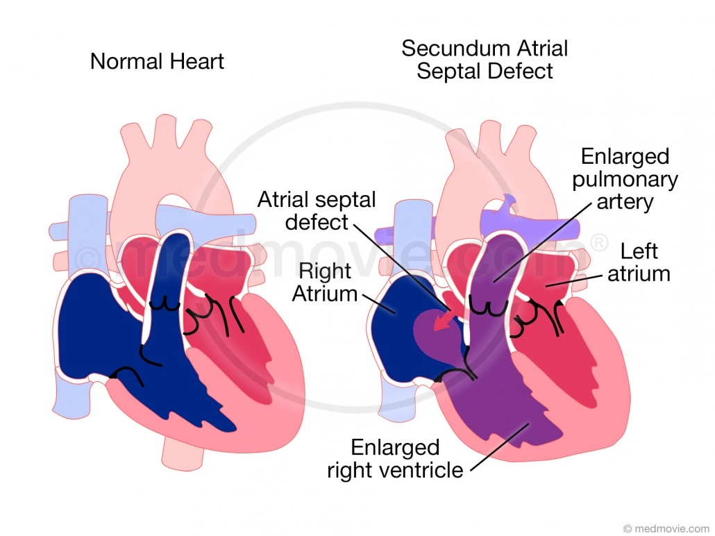 Primum Atrial Septal Defect