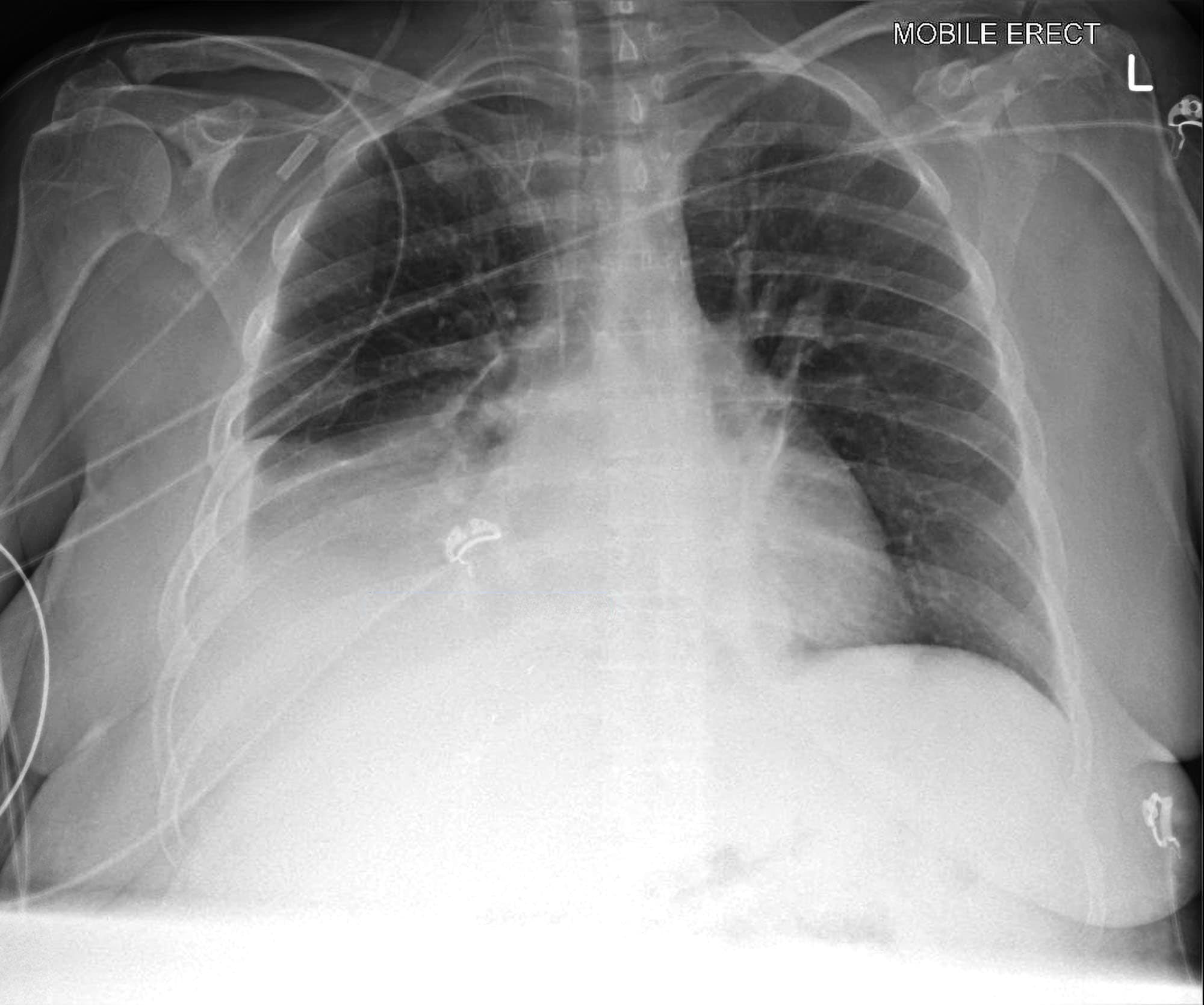 Chest X Ray Consolidation Vs Atelectasis at Bethany Barrett blog