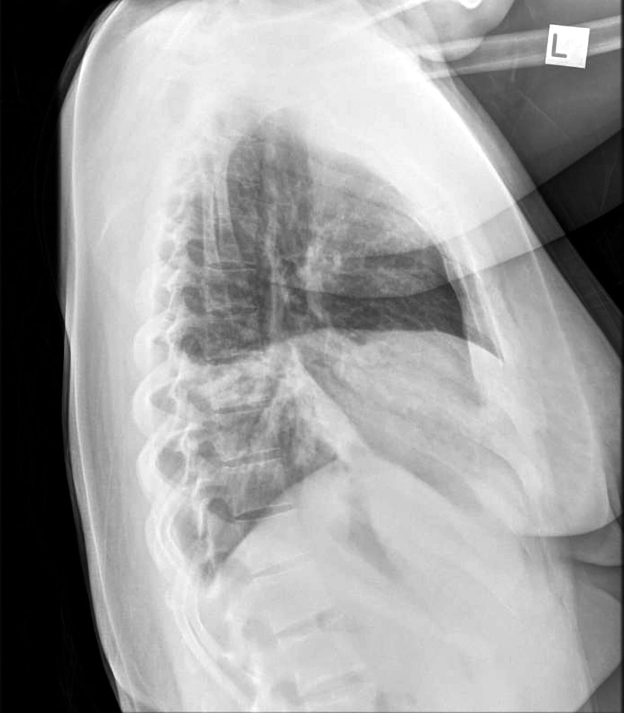 Pneumonia Lateral Chest X Ray