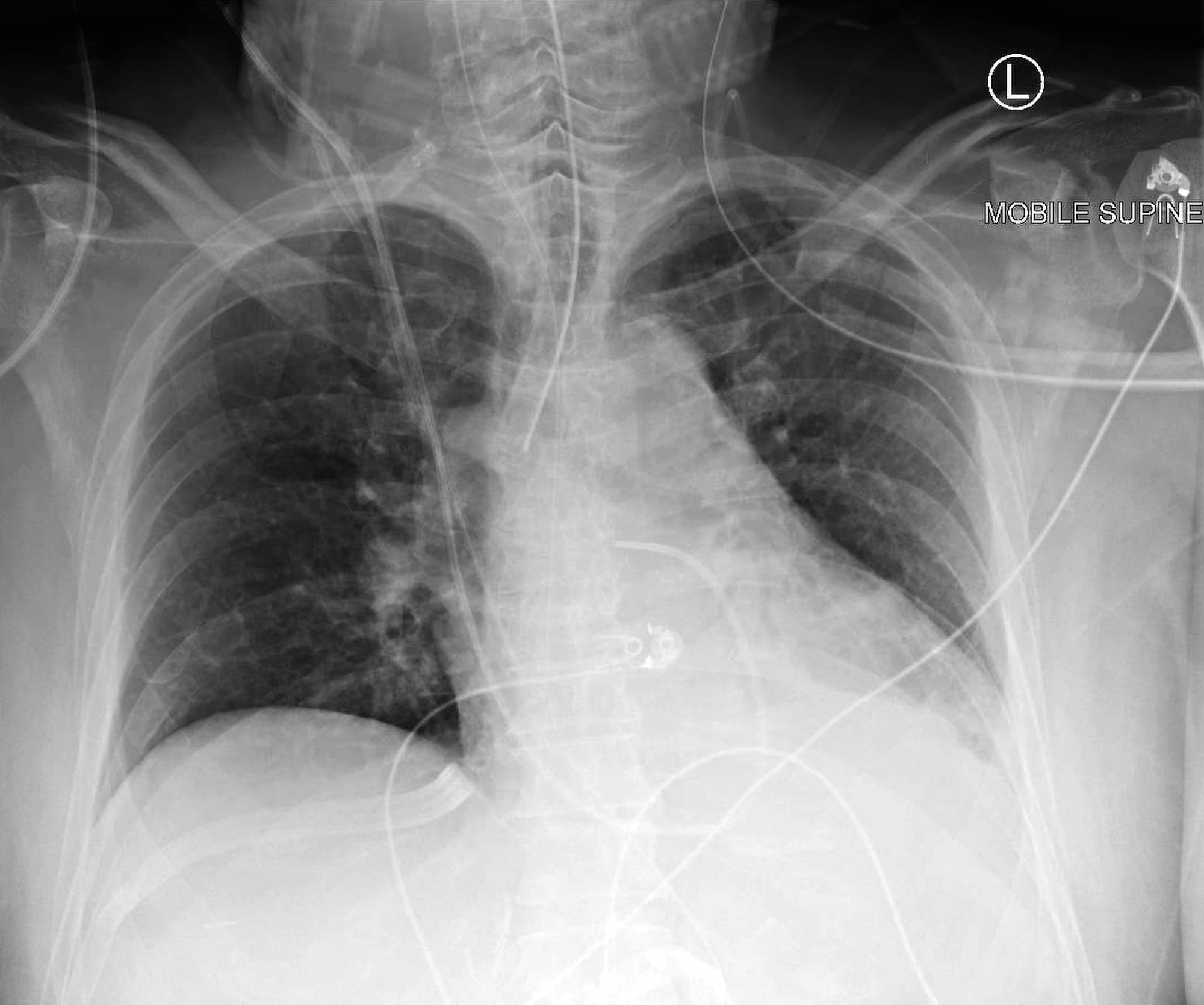 Chest X Ray Showing Right Sided Chest Tube Placement - vrogue.co