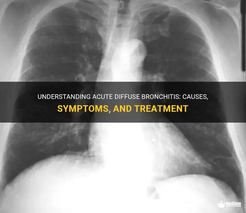 Understanding Acute Diffuse Bronchitis: Causes, Symptoms, And Treatment ...