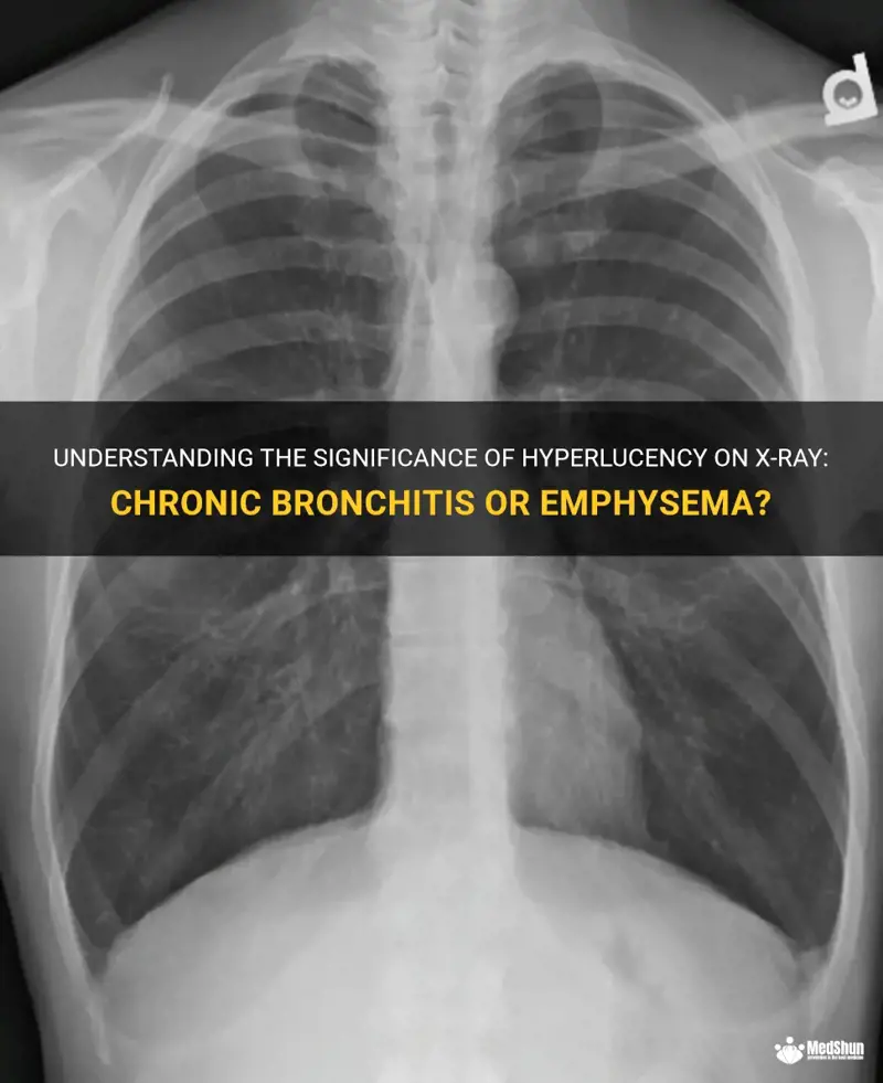 Understanding The Significance Of Hyperlucency On X-Ray: Chronic ...