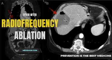 Managing Fever After Radiofrequency Ablation: What to Know