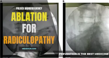 Exploring the Benefits of Pulsed Radiofrequency Ablation for Radiculopathy: An Innovative Treatment Approach