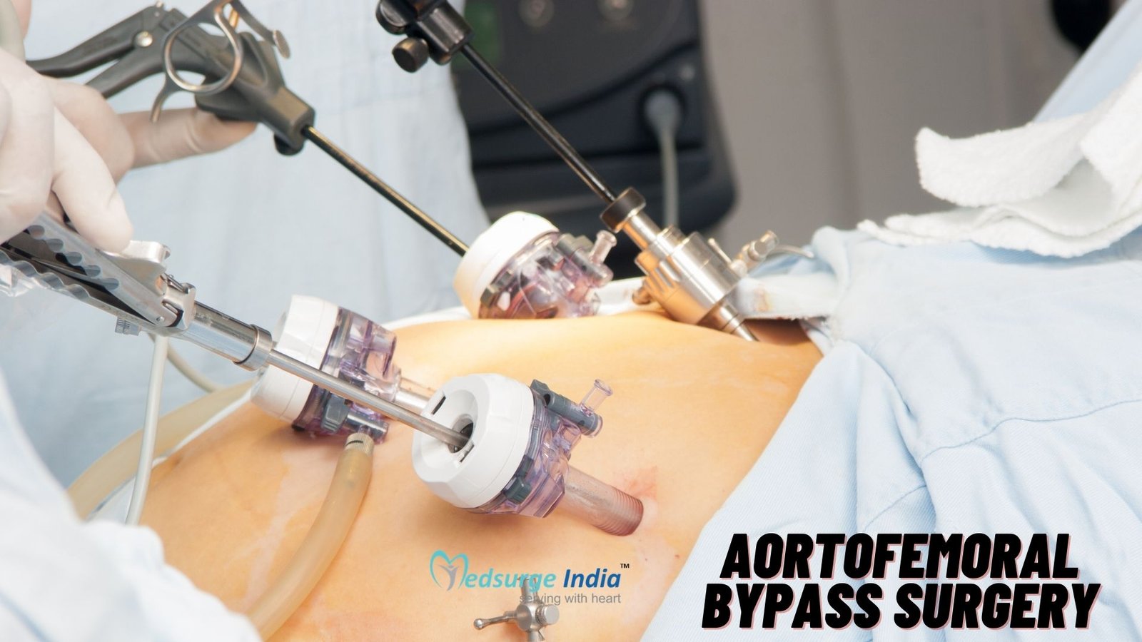 Aortobifemoral Bypass Surgery In India- Uganda Patient Story