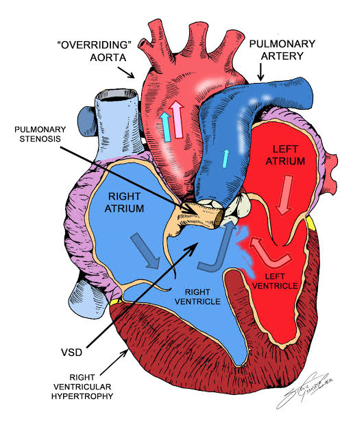 Tetralogy of fallot - Med-zone TV