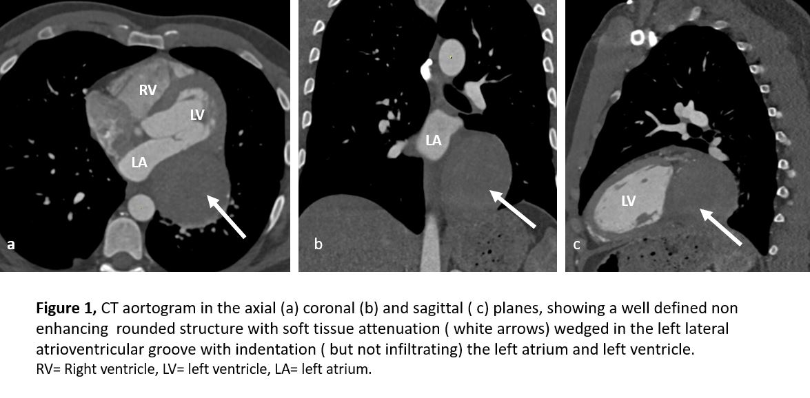 ISMICS - Rare Case Of Giant Coronary Artery Aneurysm With Diagnostic ...