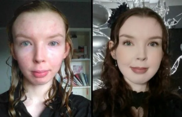 mewing before after result age 20