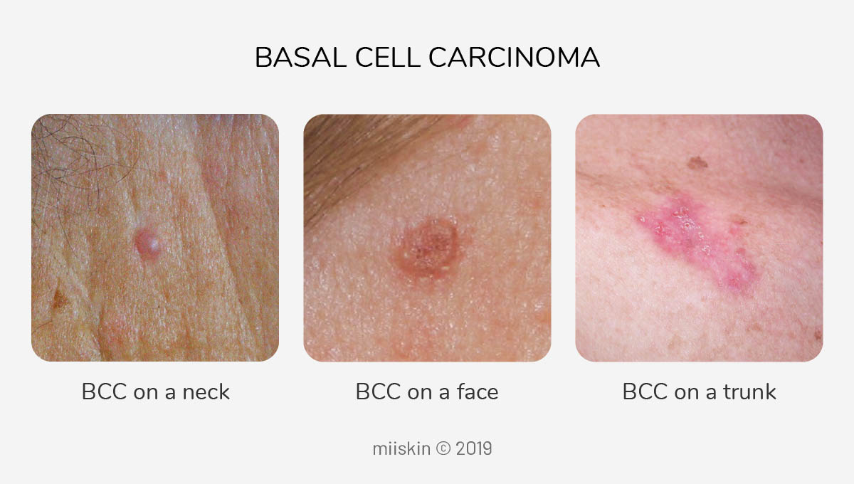 Basal Cell Carcinoma Types