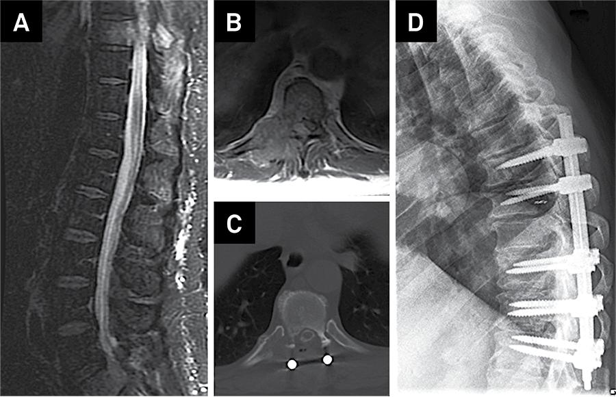 SciELO - Brasil - An update in the management of spinal metastases An ...