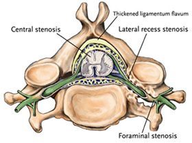 Foraminal stenosis is a condition that arises when the spaces between the vertebrae shrink.