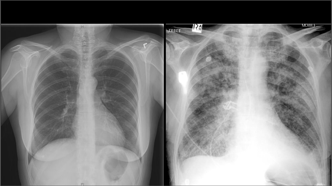 Chest X Ray Pneumonia Vs Chf at Melissa Eaton blog