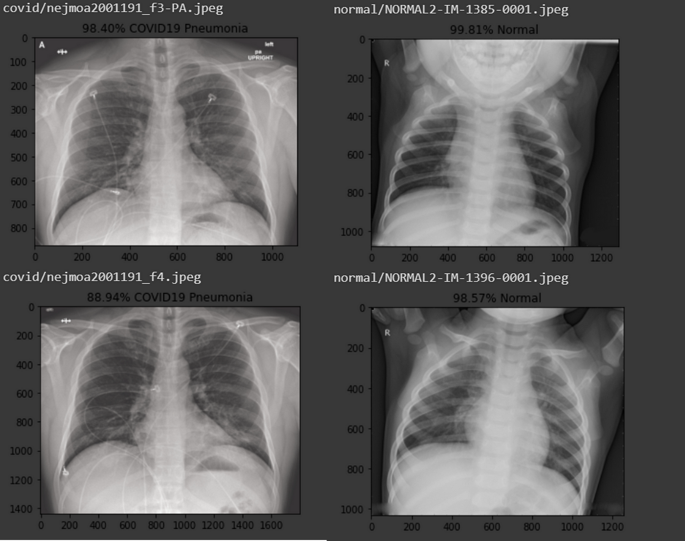 Transfer Learning Exploits Chest-Xray To Diagnose COVID-19, 46% OFF