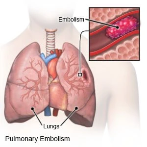 Pulmonary Embolism Cause, Symptom, Treatment - Mobile Physio