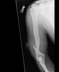 humerus fracture