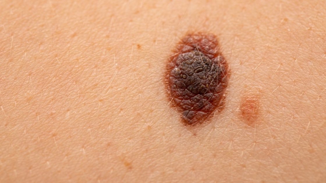 Malignant Melanoma (MM) Skin Cancer Treatment