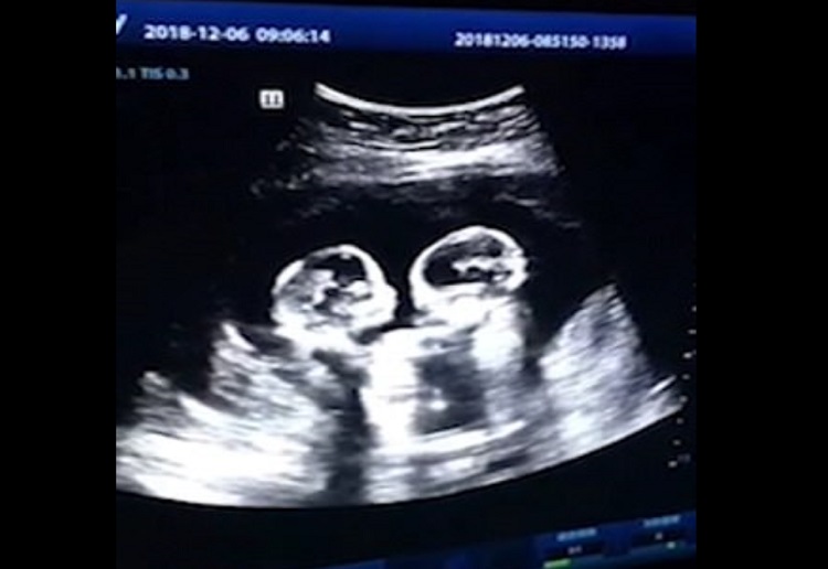 Identical Twins Spotted 'Fighting' in Mother's Womb - Mouths of Mums