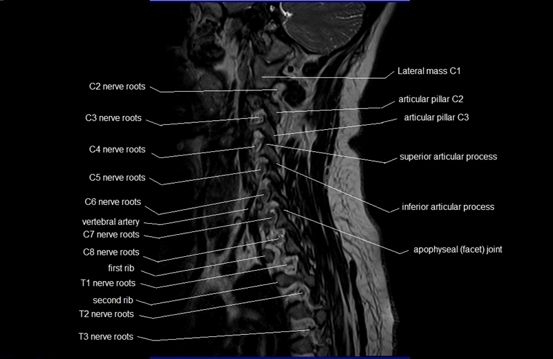 C spine Anatomy |MRI Cervical Spine Sagittal Anatomy