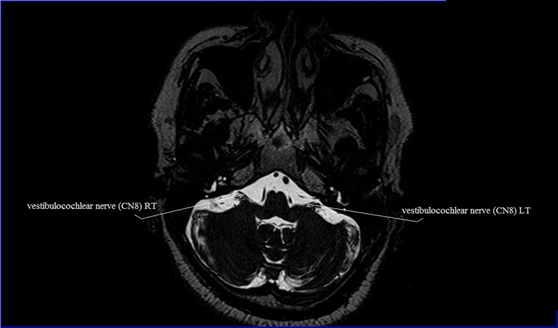 Cranial Nerves Anatomy | MRI Axial Cranial Nerves Anatomy | Free Cross ...