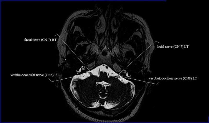 Cranial Nerves Anatomy | MRI Axial Cranial Nerves Anatomy | Free Cross ...