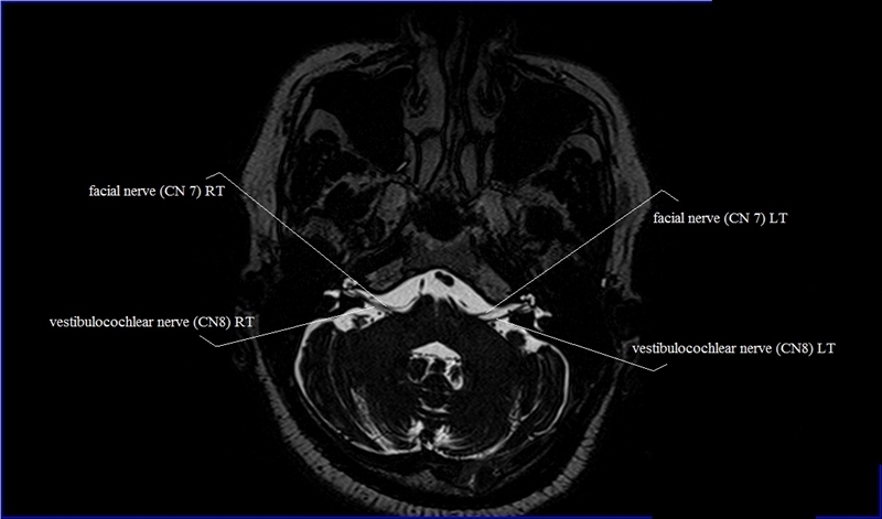 Cranial Nerves Anatomy | MRI Axial Cranial Nerves Anatomy | Free Cross ...