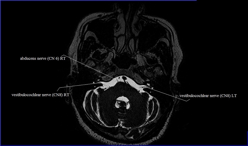 Cranial Nerves Anatomy | MRI Axial Cranial Nerves Anatomy | Free Cross ...