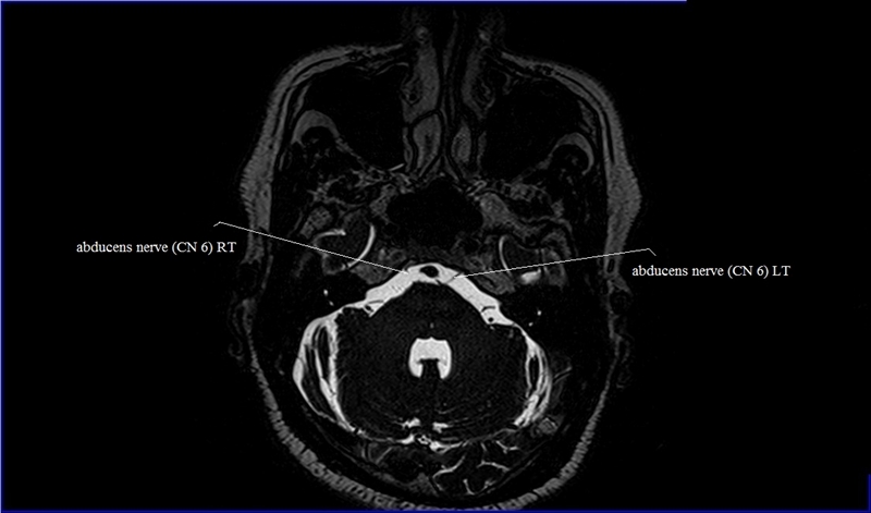 Cranial Nerves Anatomy | MRI Axial Cranial Nerves Anatomy | Free Cross ...