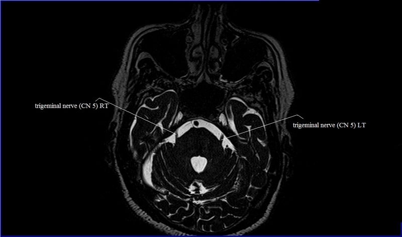 Cranial Nerves Anatomy | MRI Axial Cranial Nerves Anatomy | Free Cross ...