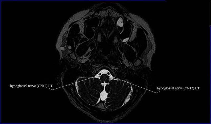 Cranial Nerves Anatomy | MRI Axial Cranial Nerves Anatomy | Free Cross ...