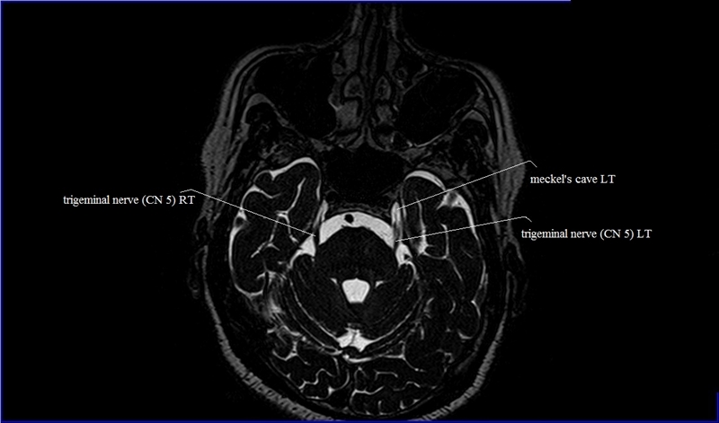 Cranial Nerves Anatomy | MRI Axial Cranial Nerves Anatomy | Free Cross ...