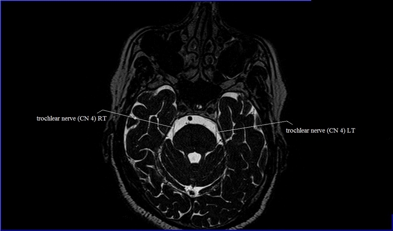 Cranial Nerves Anatomy | MRI Axial Cranial Nerves Anatomy | Free Cross ...