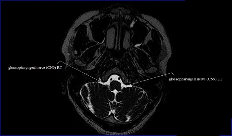 Cranial Nerves Anatomy | MRI Axial Cranial Nerves Anatomy | Free Cross ...