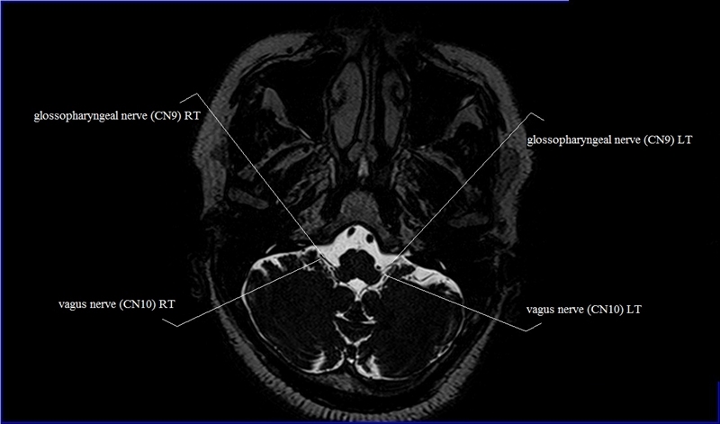 Cranial Nerves Anatomy | MRI Axial Cranial Nerves Anatomy | Free Cross ...