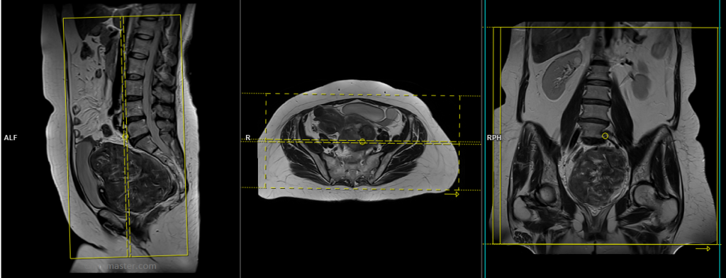 Uterine Fibroid MRI Protocol | Fibroid Mapping MRI Protocol and Planning