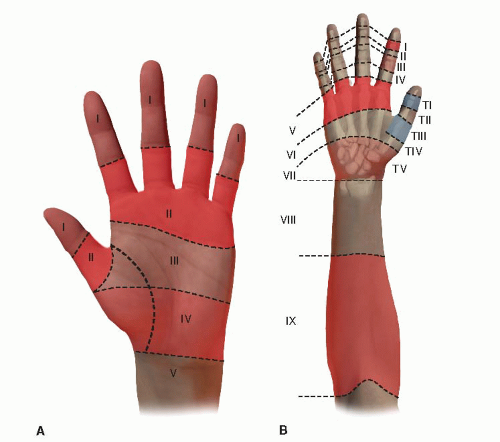 Zones Of Extensor Tendon Injury