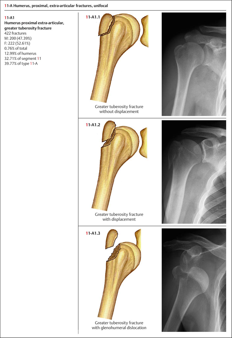 Greater Tubercle Of Humerus