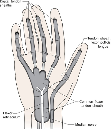 RHEUMATOID ARTHRITIS AND THE HAND | Musculoskeletal Key