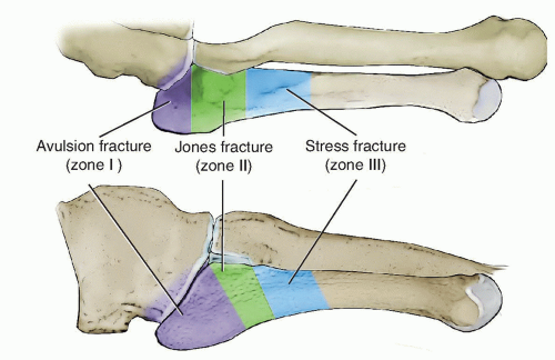 Surgical Management Of Proximal Fifth Metatarsal Fractures Musculoskeletal Key