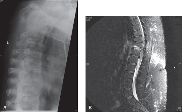 Ankylosing Spondylitis | Musculoskeletal Key