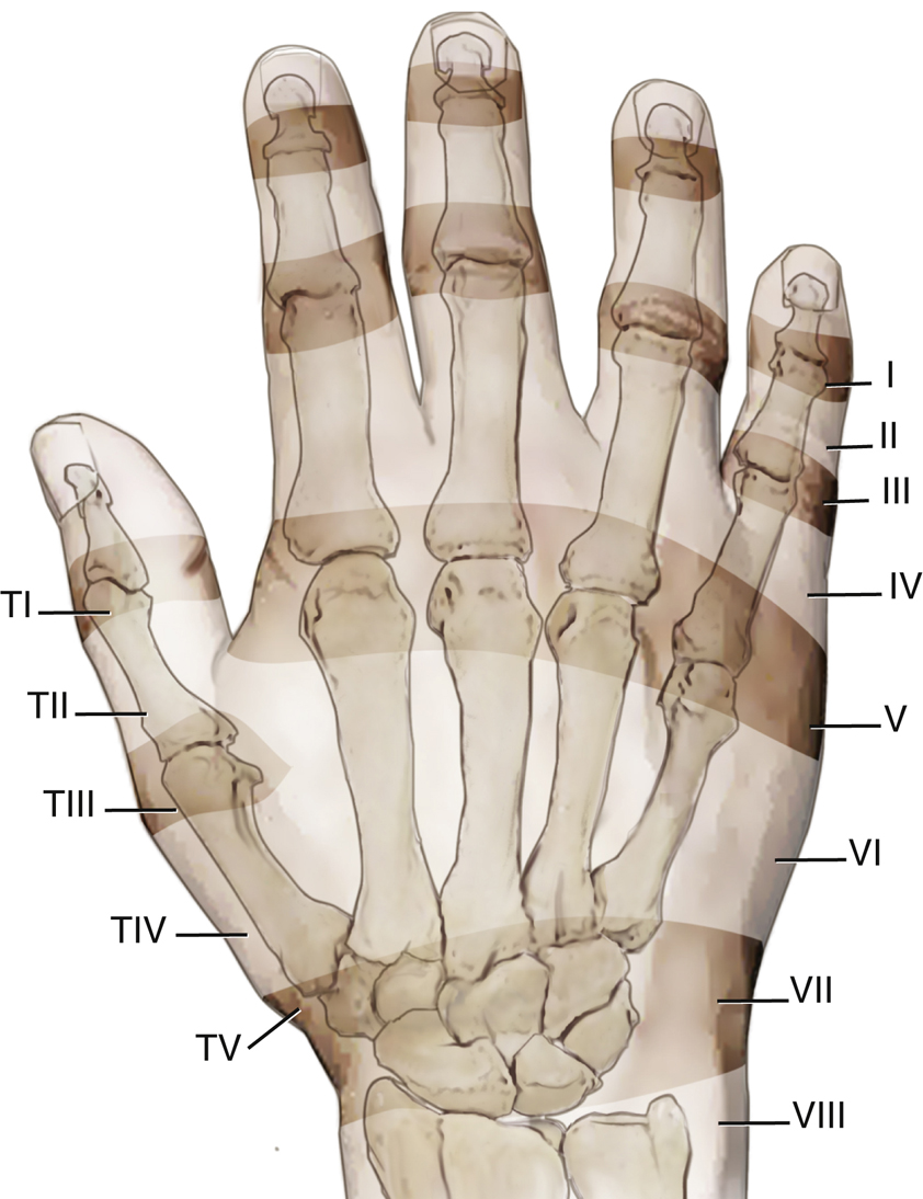 Extensor Tendon Repair | Musculoskeletal Key