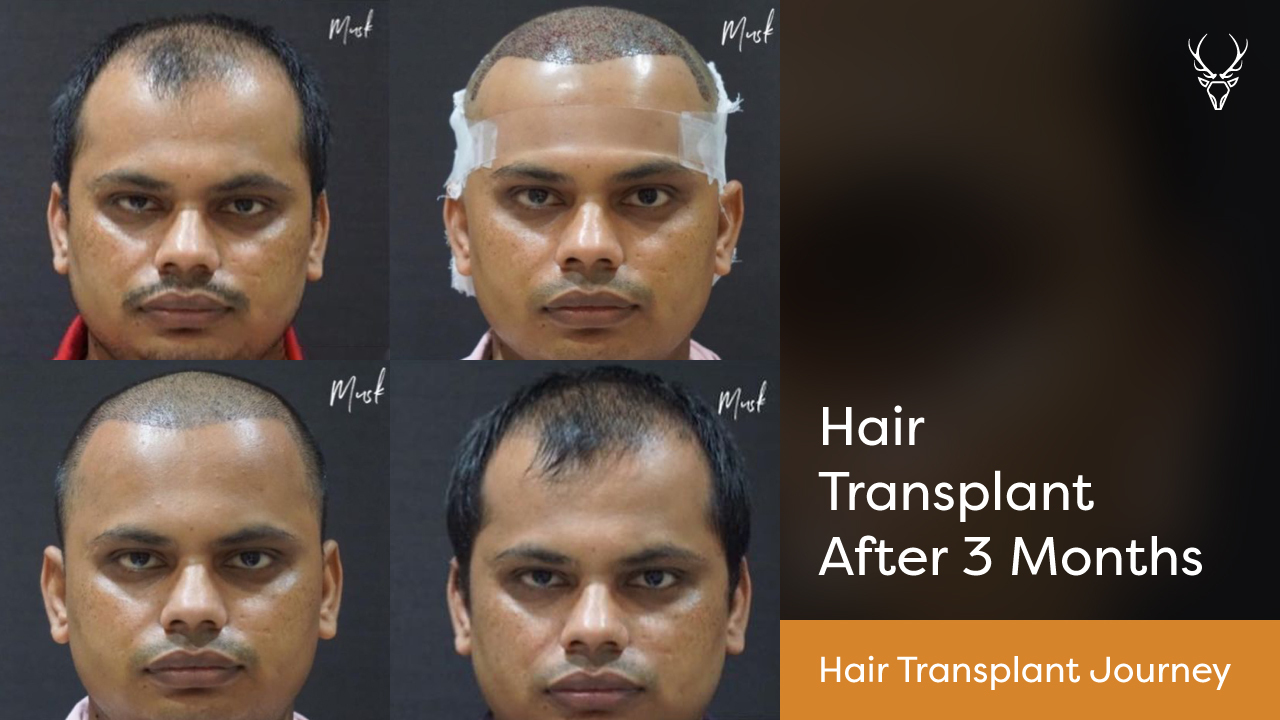 Hair Restoration Recovery