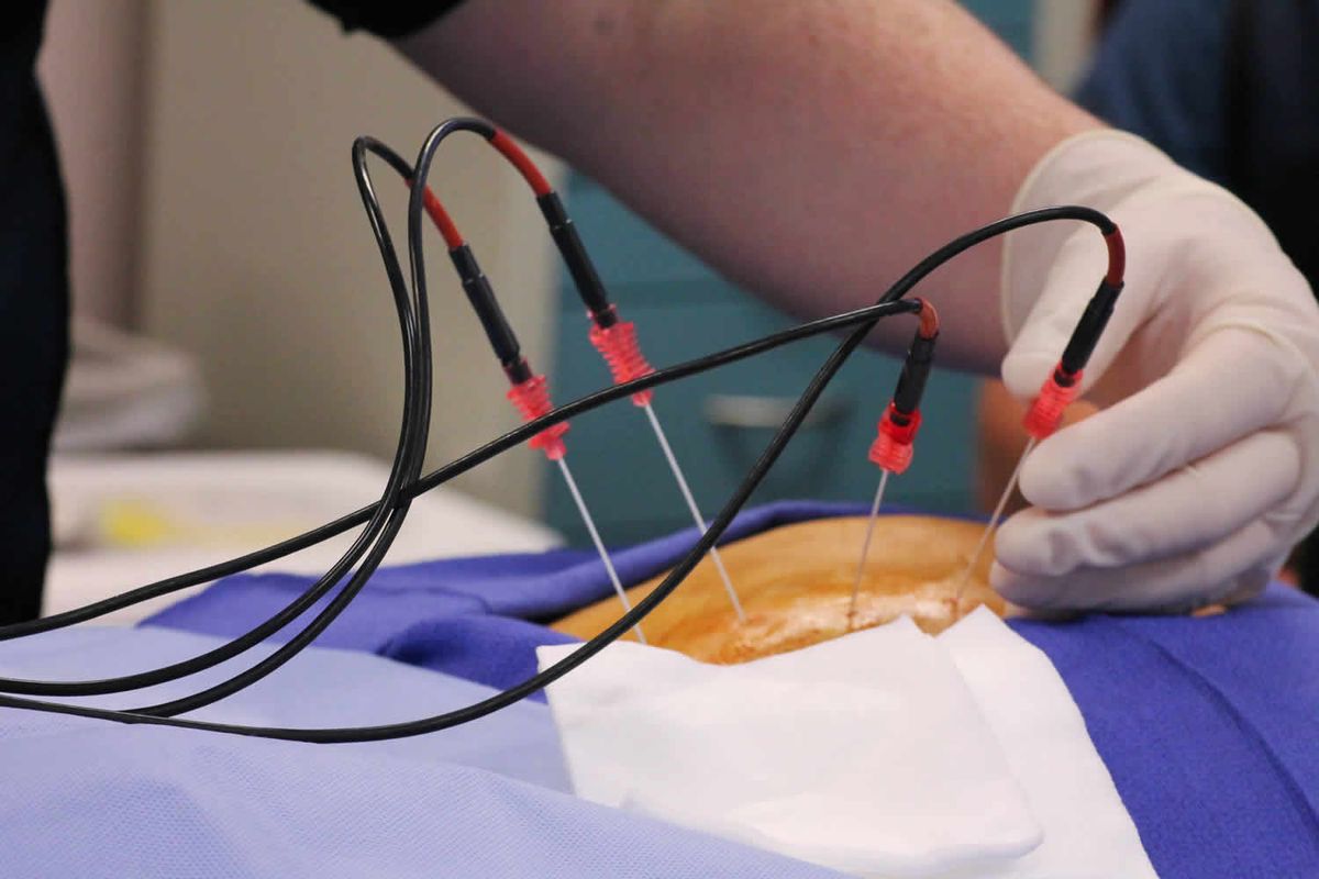 What is Radiofrequency Ablation (RFA)? - MVM Health - Pain, Vein & Wellness