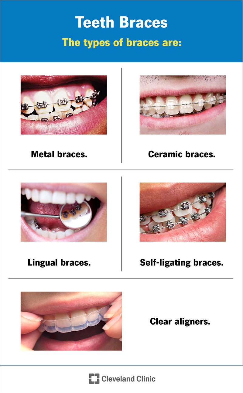 How Braces Work: Different Types of Orthodontics - Vondran Orthodontics