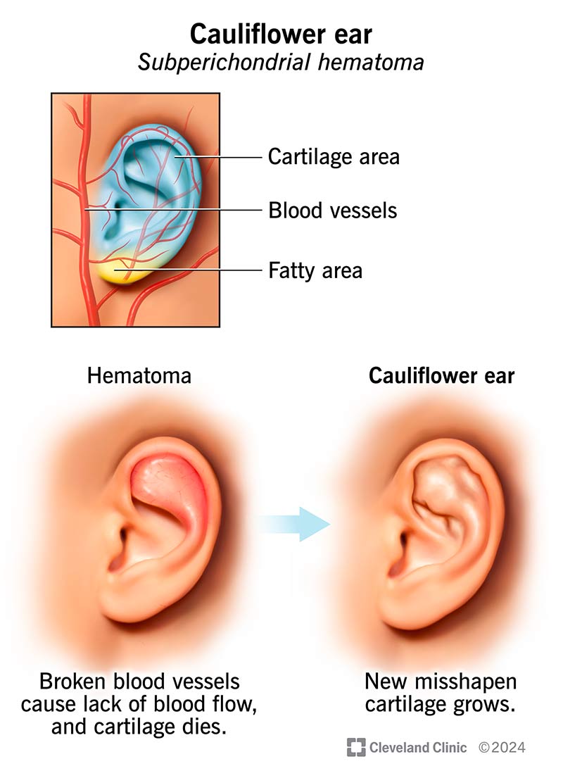 Cauliflower ear is when broken blood vessels cut off blood flow, causing scar tissue and misshapen cartilage to grow