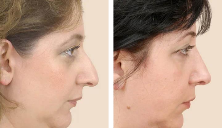 Rhinoplasty (Nose Job): Surgery, Recovery, Before & After