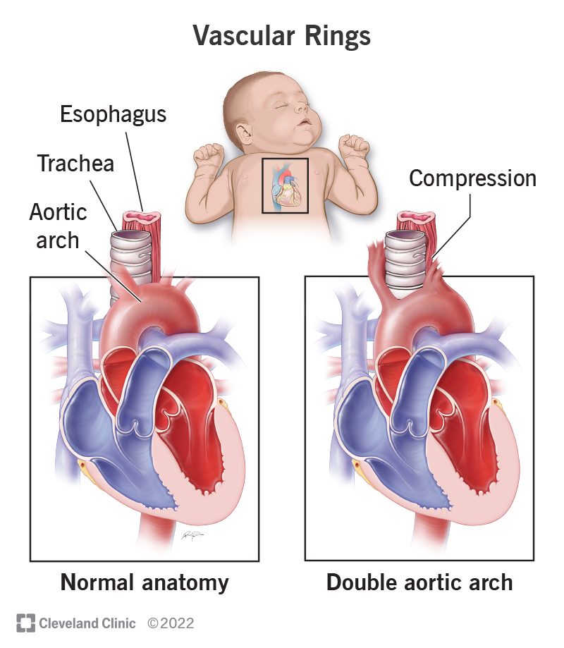 Vascular Rings: Causes and Symptoms