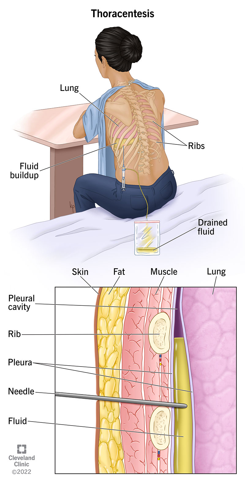 Thoracentesis Fluid