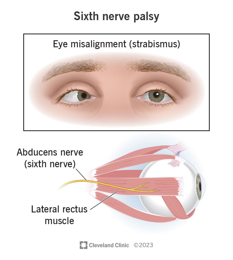 Sixth Nerve Palsy: Causes, Symptoms & Treatment