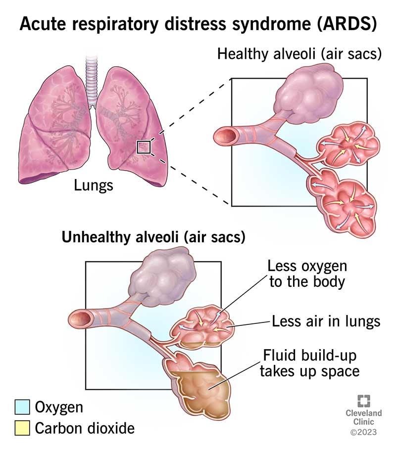 Acute Respiratory Distress Syndrome (ARDS)