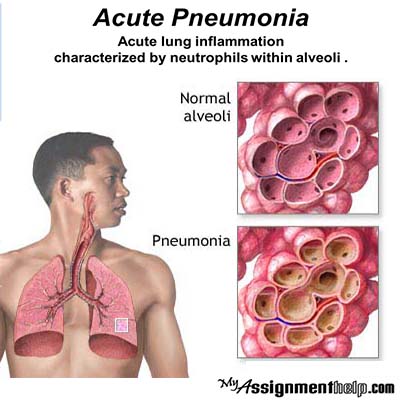 Know how to take proper care of acute Pneumonia patients